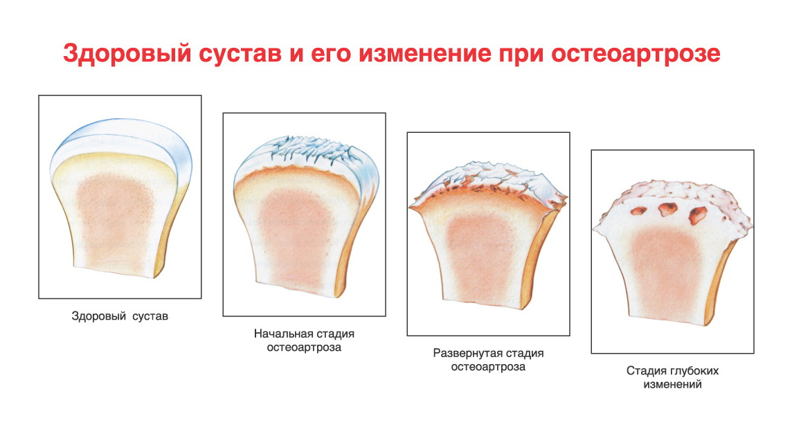 Боль в суставах ОртоМед